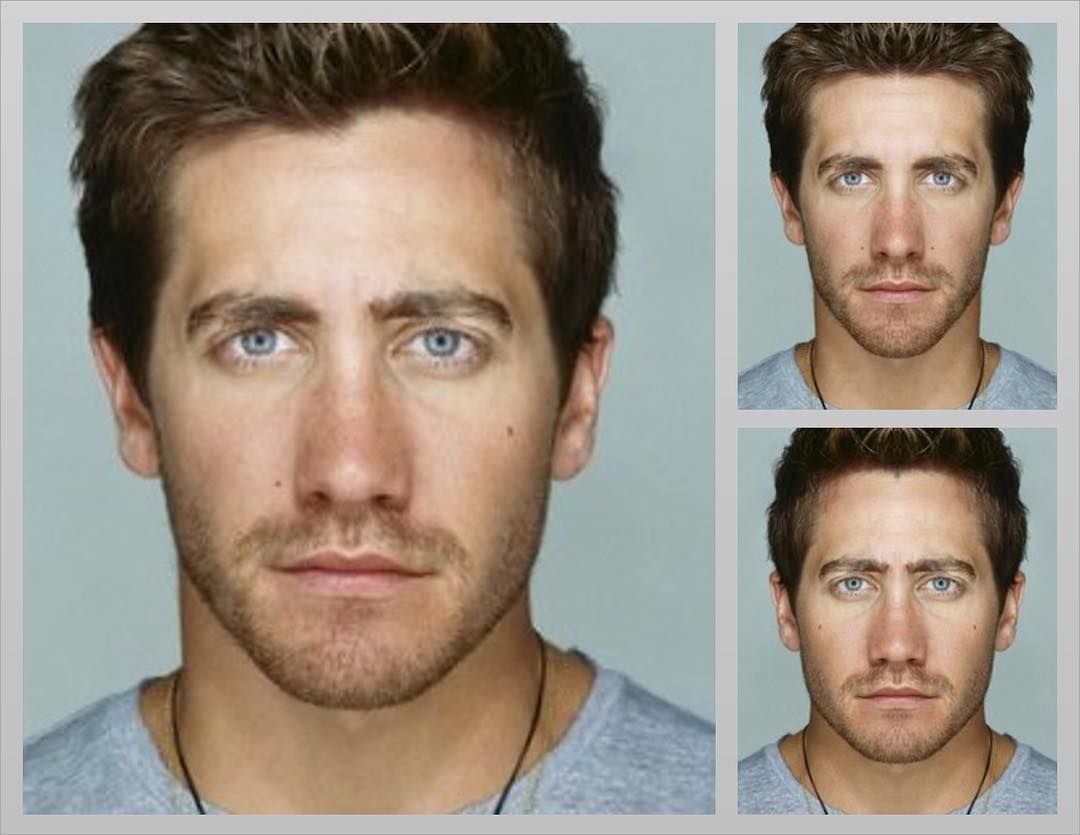 How are Asymmetrical Eyes Treated?