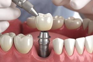 How Modern Dental Implant Care Is Planned for a Natural, Functional Smile